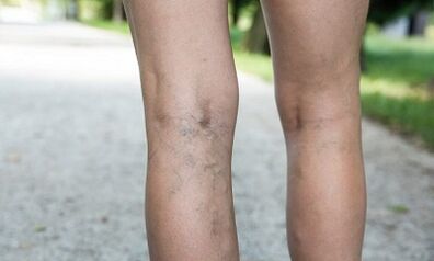 Die Gründe für die Entwicklung von Krampfadern bei Frauen