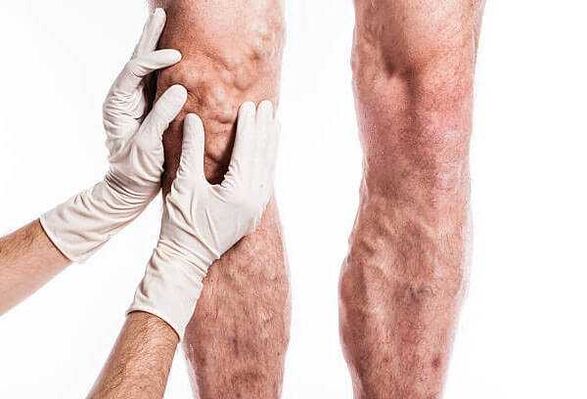 Palpation von Krampfadern an den Beinen