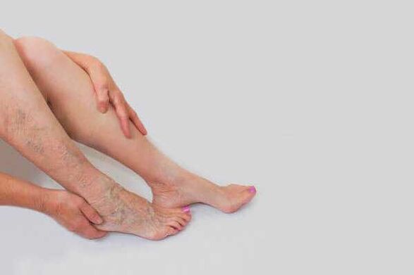 Vorstehende erweiterte Venen sind ein Zeichen für Krampfadern der unteren Extremitäten